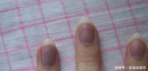 皮肤科|指甲这6个现象,暗示你生病了,要注意,第一个代表患有心脏病