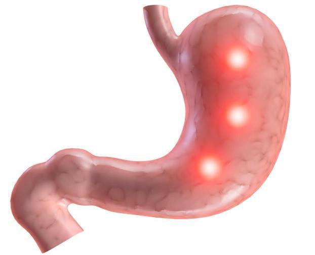 腺瘤性息肉|息肉和癌症有什么关系告诫3个部位长息肉,最好及时切除