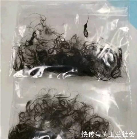 毛毛|16个小时“拉丝”手术，用坏6把异物钳！心疼，3岁女孩胃里取出两袋头发