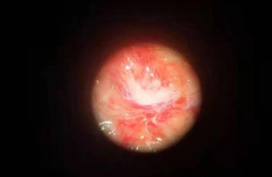 女孩|爱毛绒玩具的女孩注意!每天抱毛绒玩具睡觉,六岁女孩眼睛长肿块