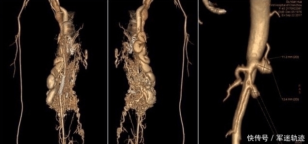 医生们|女孩大腿异常肿痛流血不止, 检查结果连医生都吓了一跳