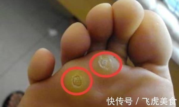 鸡眼|原来鸡眼是这么来的，四个小妙招，教你轻松解除多时的困惑！