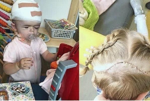 ell女孩生下来就“整容”,被医生打碎骨头重造,如今5岁美出天际