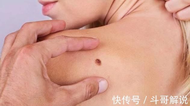 肝脏|4个部位长出痣，为健康最好定期检查，以防癌症悄悄接近你
