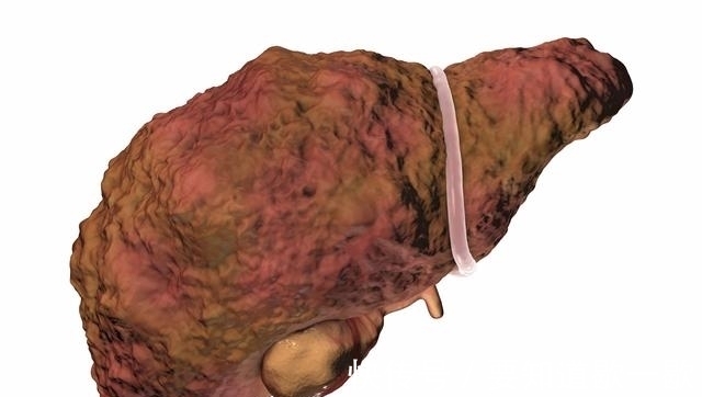 肝硬化|肝硬化不治疗会引起肝衰竭甚至肝癌,一定要做好4点来预防!