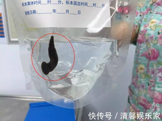 检查|4岁女孩常流鼻血,去医院检查却被送手术室,妈妈表示都怪我