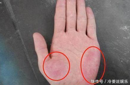 肝功能|不论男女,若手上没有这3个“标志”,恭喜,你的肝脏还很健康!