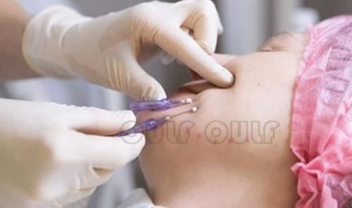 全脸埋线多久恢复自然、线雕恢复期是多久