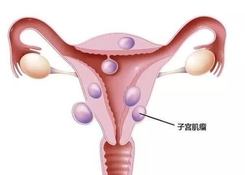 排出體外|子宮肌瘤的“天敵”，女人常吃，活血化淤，子宮慢慢變好！