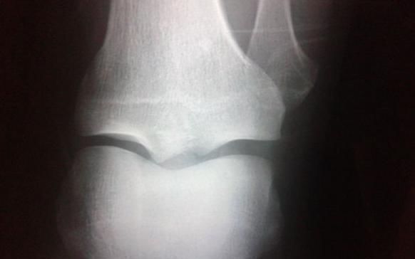 性早熟|警惕8岁女孩骨垢线就闭合,罪魁祸首很常见,家长却经常忽略