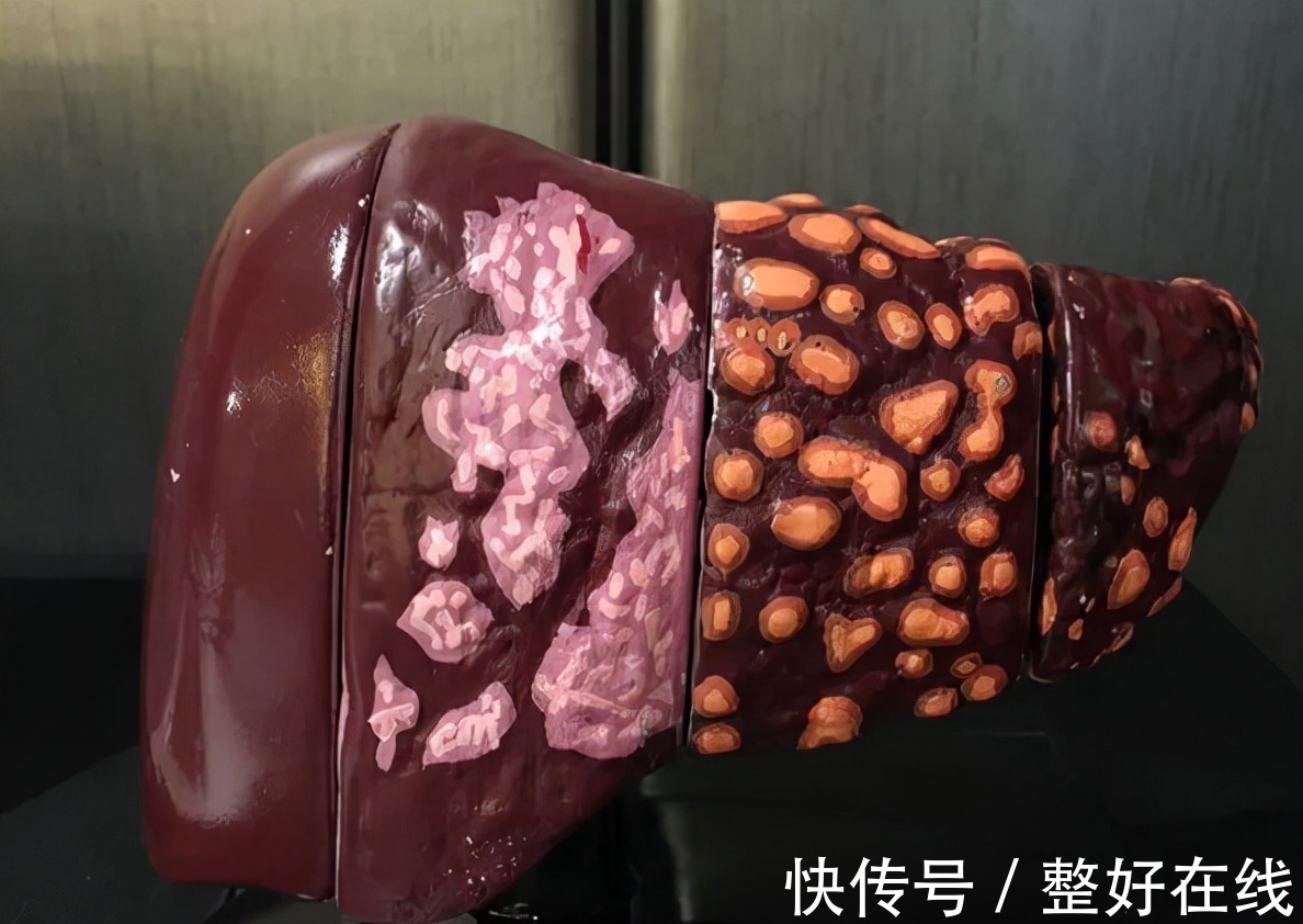 治疗|从乙肝到肝硬化到底需要多久?专家提醒:4种方法可预防肝硬化