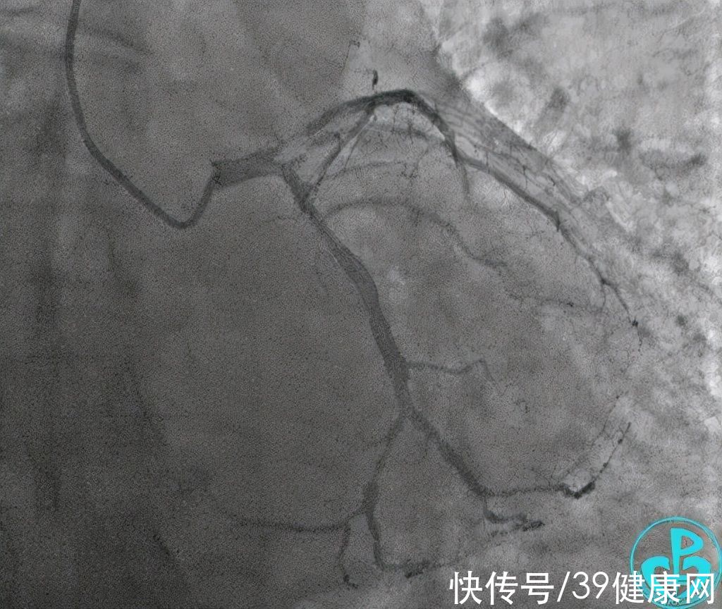 刘鸣|60岁男子心梗，植入支架20分钟后死亡！心脏支架该被淘汰了？