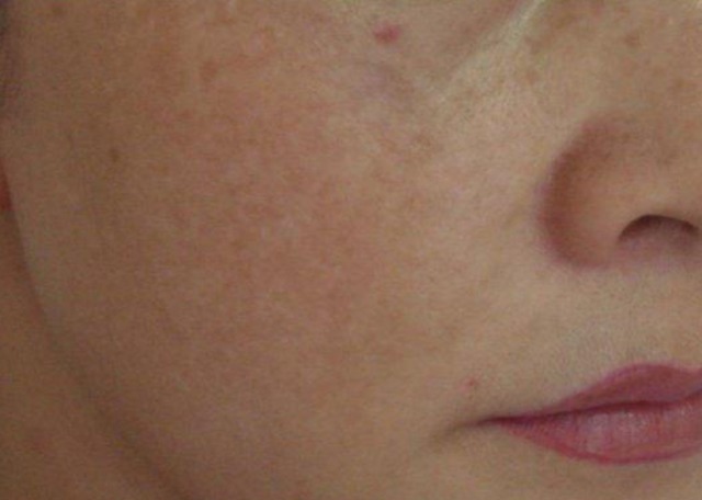 皮肤|87岁院士研究黄褐斑60年，提醒：三种食物易“烂脸”，少吃为好