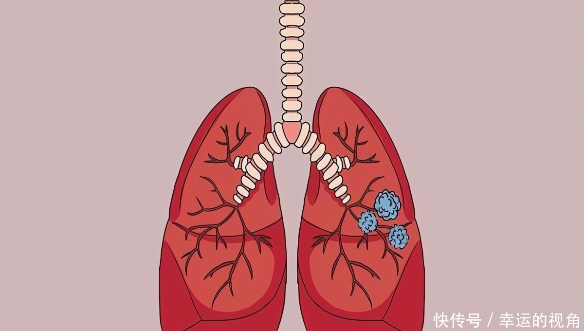 女子患上肺结节后复查，肺结节得到缓解，可能归功于常做四件事