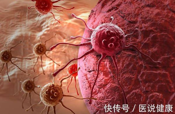 肝癌|肝不好,脸先知!医生:脸上若有这3个特征,或是肝脏癌变的信号