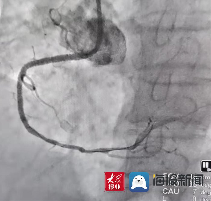 菏泽医专|菏泽医专附属医院成功救治94岁急性心肌梗死患者