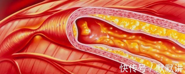 血压升高|高血压患者谨记少吃2物,坚持2事,血压慢慢降回“安全线”