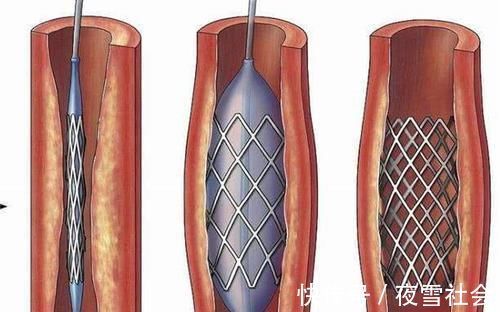 冠心病|冠心病放了支架，能不能做核磁？2007年之后放支架的人需注意