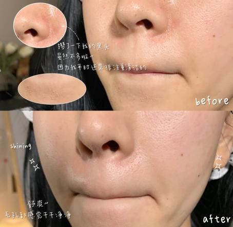 皮肤爱出油经常长闭口？那是你没选对清洁面膜吧！