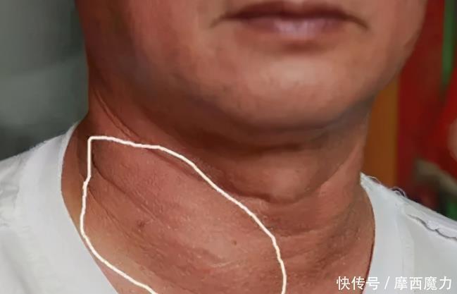 甲状腺结节不会无故产生的,很可能与5个习惯有关系,你有就改掉