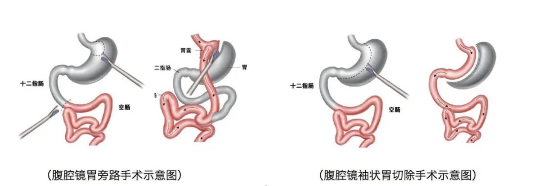 季峰|切胃减重80斤，29岁姑娘却遭遇术后并发症！专家痛心呼吁：科学减肥，安全第一