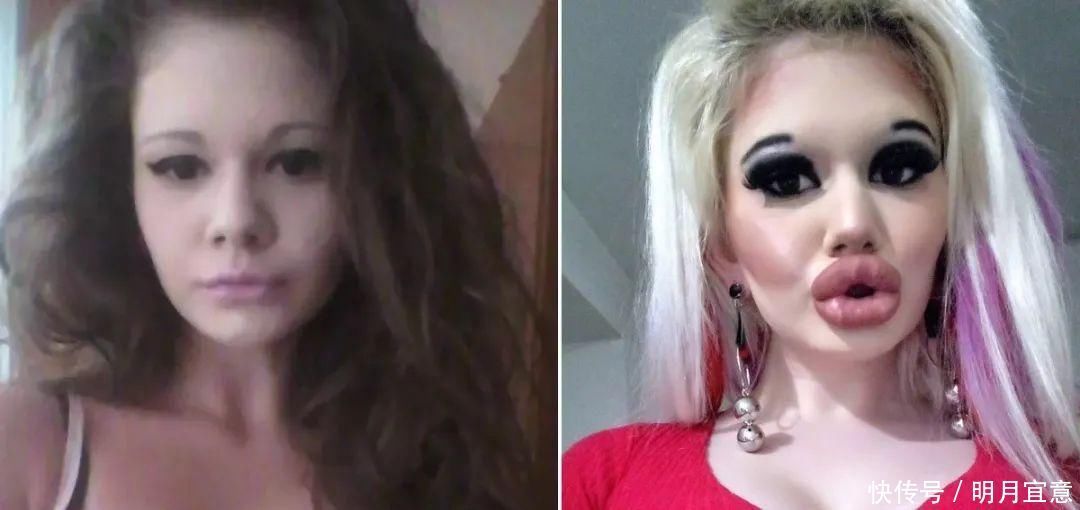 21次丰唇手术之后，这个妹子的嘴唇现在长这样…
