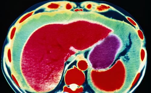 肝硬化|河南50岁大姐,查出肝硬化,每日坚持吃菠菜养肝,后来怎么样了?