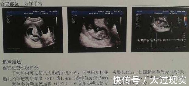 开头|四维彩超上的“信息”可能暗示了宝宝的“性别”,孕妈了解一下!