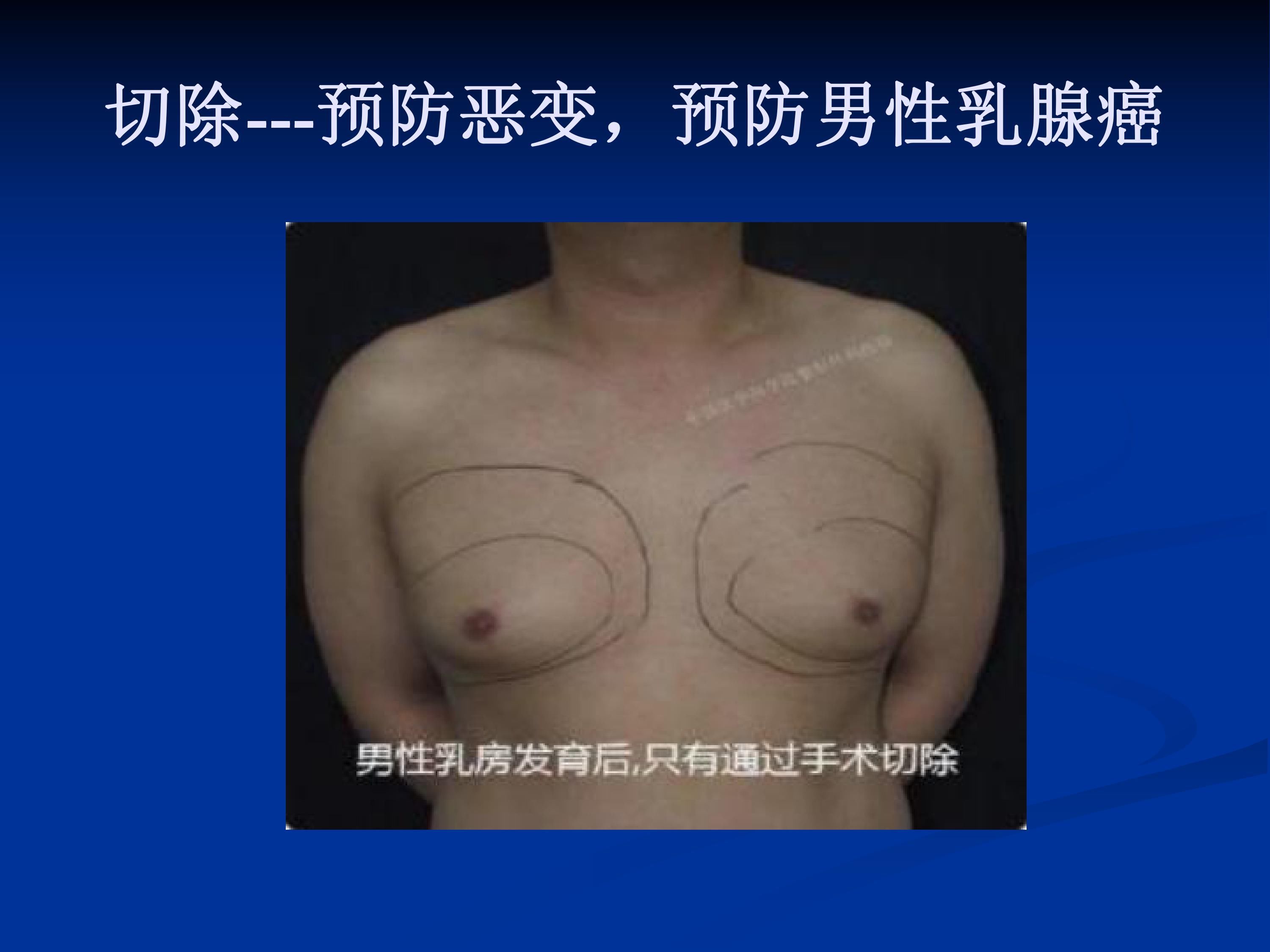 乳房|“乳”此爱你----关注男性乳房健康