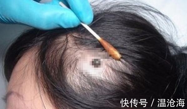 蜱虫|4岁女儿高烧不退,呕吐不止,拨开头发,怀孕准妈妈怒扇婆婆耳光