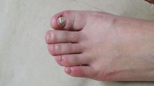 腿部|血脂高不高，”小腿“先知？医生：血脂偏高，身体或有这几个表现