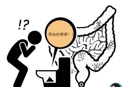  里急后重|肠道有癌，排便先知！医生提醒：排便出现4种异常，尽早检查