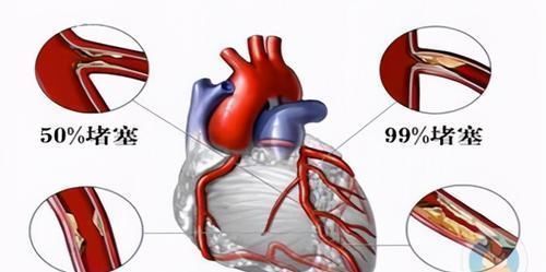 动脉粥样硬化|发现“动脉斑块”,还能逆转或消失吗心脏医生给出靠谱答复
