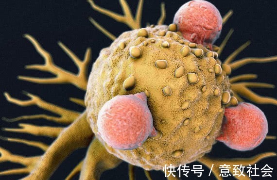 肠癌|肠癌、宫颈癌有共同信号，上厕所出现1种“迹象”，疾病已在候命