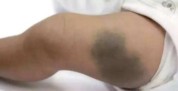 产科医生|胎记是怎么回事产科医生孕期尽量避开3种行为,以免胎儿自卑