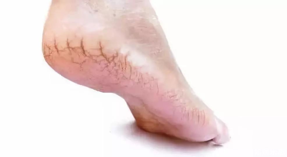 小腿长“鱼鳞”，脚后跟炸裂！这么做，还你水嫩肌肤！赶紧收藏！