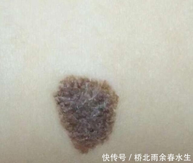 小美担心|新生儿脸上有胎记,询问医生后找到原因,这3种行为孕期别再做!