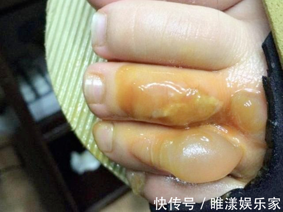 薯条|4岁孙子掉入150度油锅,奶奶的处理太及时,医生多亏奶奶专业