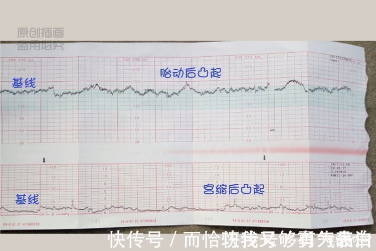 胎动|孕妇都需要做的“胎心监护图”是啥？你会看那张图吗？其实很简单