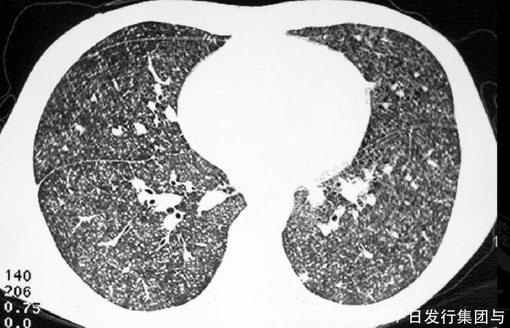 肺病|57岁肺病主任张超：肺结节1厘米以下，坚持3件事，肺脏或会通透