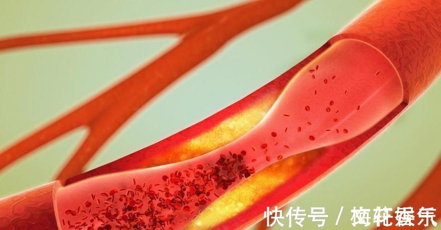 胆固醇|脸上有2个症状,说明血脂很高了,调理高血脂只要2招