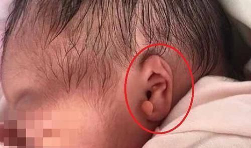 高龄产妇|孕期产检指标正常,孕妈却生下“畸形儿”,得知原因夫妻俩很崩溃