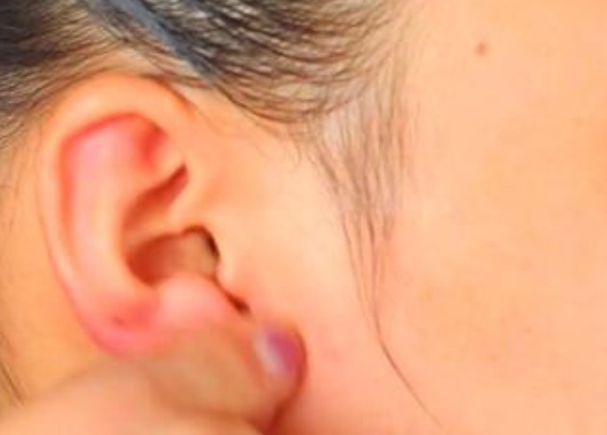 眼角膜|血脂高不高，看脸如果脸上有4种表现，要注意降低血脂了