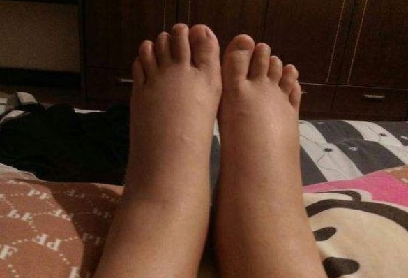 间歇性|“血管堵，脚先知”，若脚上没有4种情况，说明血管依旧“年轻”