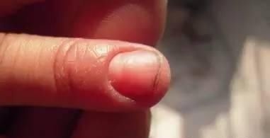 孩子|喜欢“啃指甲”的孩子,长大后会变成啥样医生逃不过两个结局
