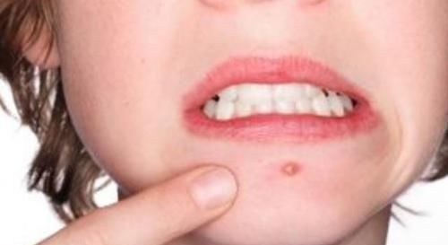 妇科病|女人有没有妇科病，看嘴就能明白，若有表现，十有八九是找上你了