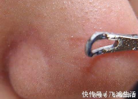 水乳|先别慌着挤黑头,这3种原因你知道了再挤也不迟