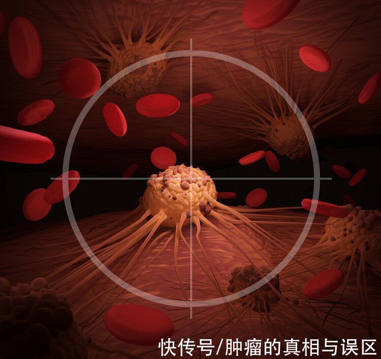 低风险癌|得了癌症就是死？提醒：2类低风险癌症，切勿过度治疗