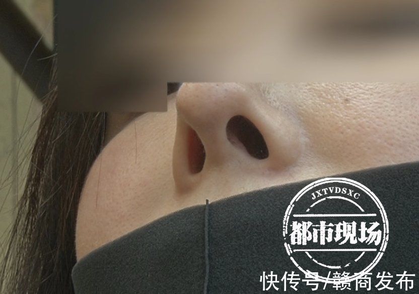 南昌 美女隆鼻整成“歪鼻女”南昌臻爱医疗美容遭投诉