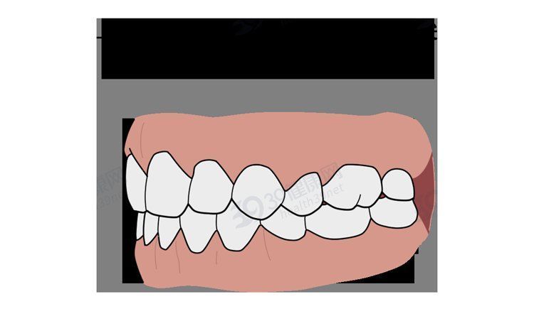 矫正|为什么只要戴牙套，牙齿就可以恢复得很整齐？生动展示矫正过程